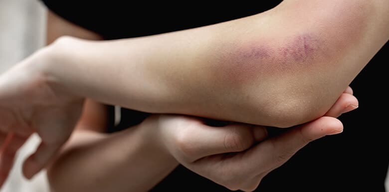 Person holding arm with large bruise on elbow and forearm